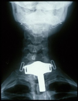 Röntgenbild Kanüle